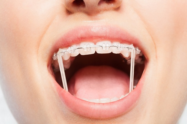 rubber for braces where to buy