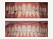 invisalign-los-altos