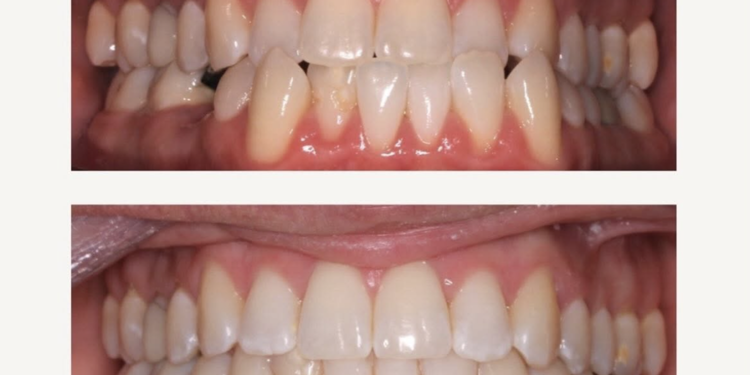 invisalign-los-altos