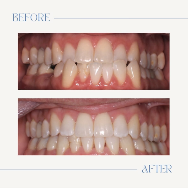 invisalign-los-altos
