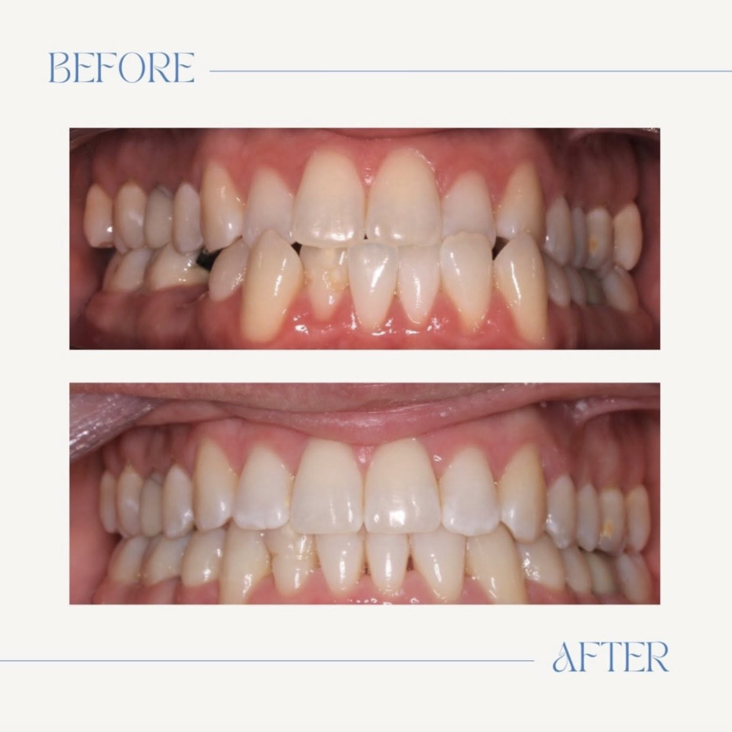 invisalign-los-altos