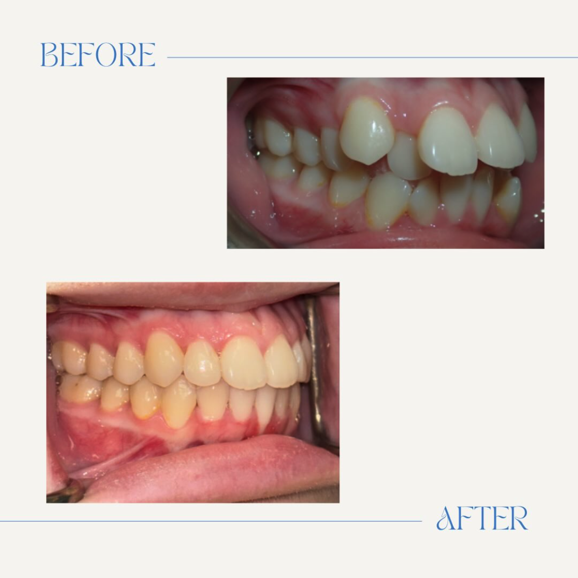 when-should-my-child-first-see-an-orthodontist